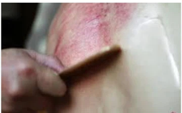 Wie gehe ich mit gebrochener Haut während Gua Sha um?